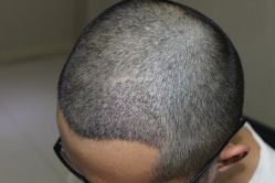 -大麦微针植发丨全国连锁