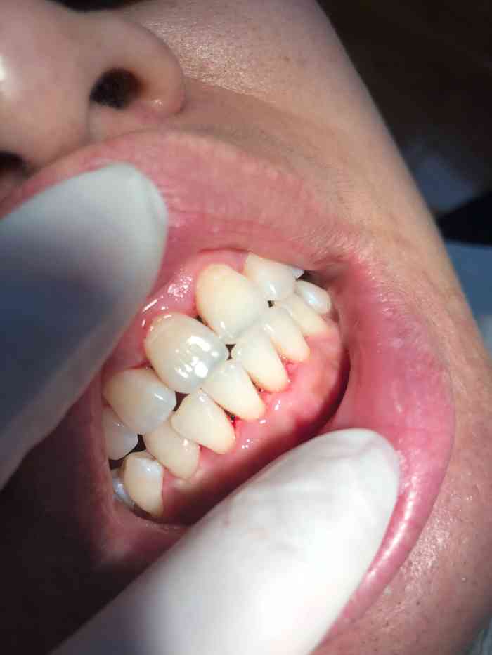 郑虹口腔-"【项目】洗牙去了补了些钱换了一个好点的.