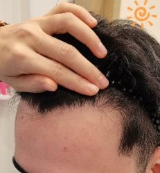 -大麦微针植发丨全国连锁