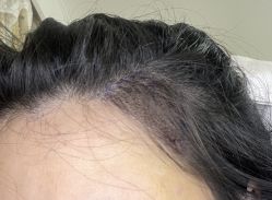 体验后-熙朵美学植发·连锁品牌