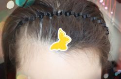 -大麦微针植发全国连锁