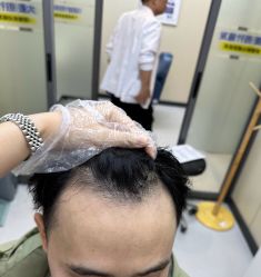-大麦微针植发全国连锁