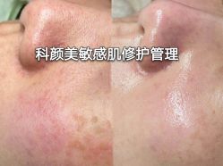 -美肤盾祛痘·问题肌头疗管理中心