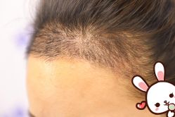 -大麦微针植发丨全国连锁