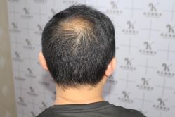 -大麦微针植发丨全国连锁