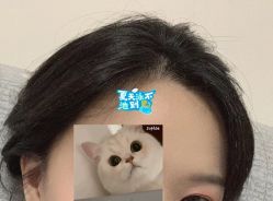 -大麦微针植发全国连锁