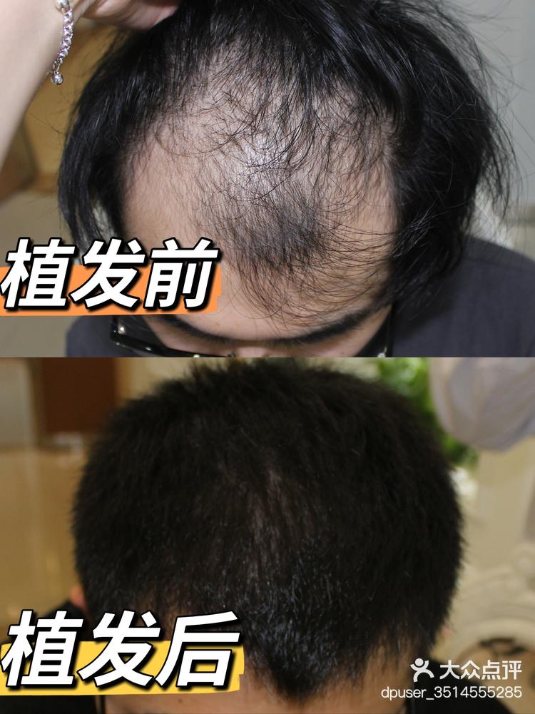 植发男人(男人植发需要多少钱)