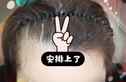 -大麦微针植发全国连锁