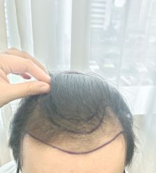 -碧莲盛·不剃发植发