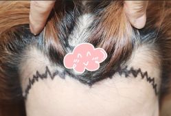 -大麦微针植发全国连锁