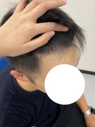 -大麦微针植发全国连锁