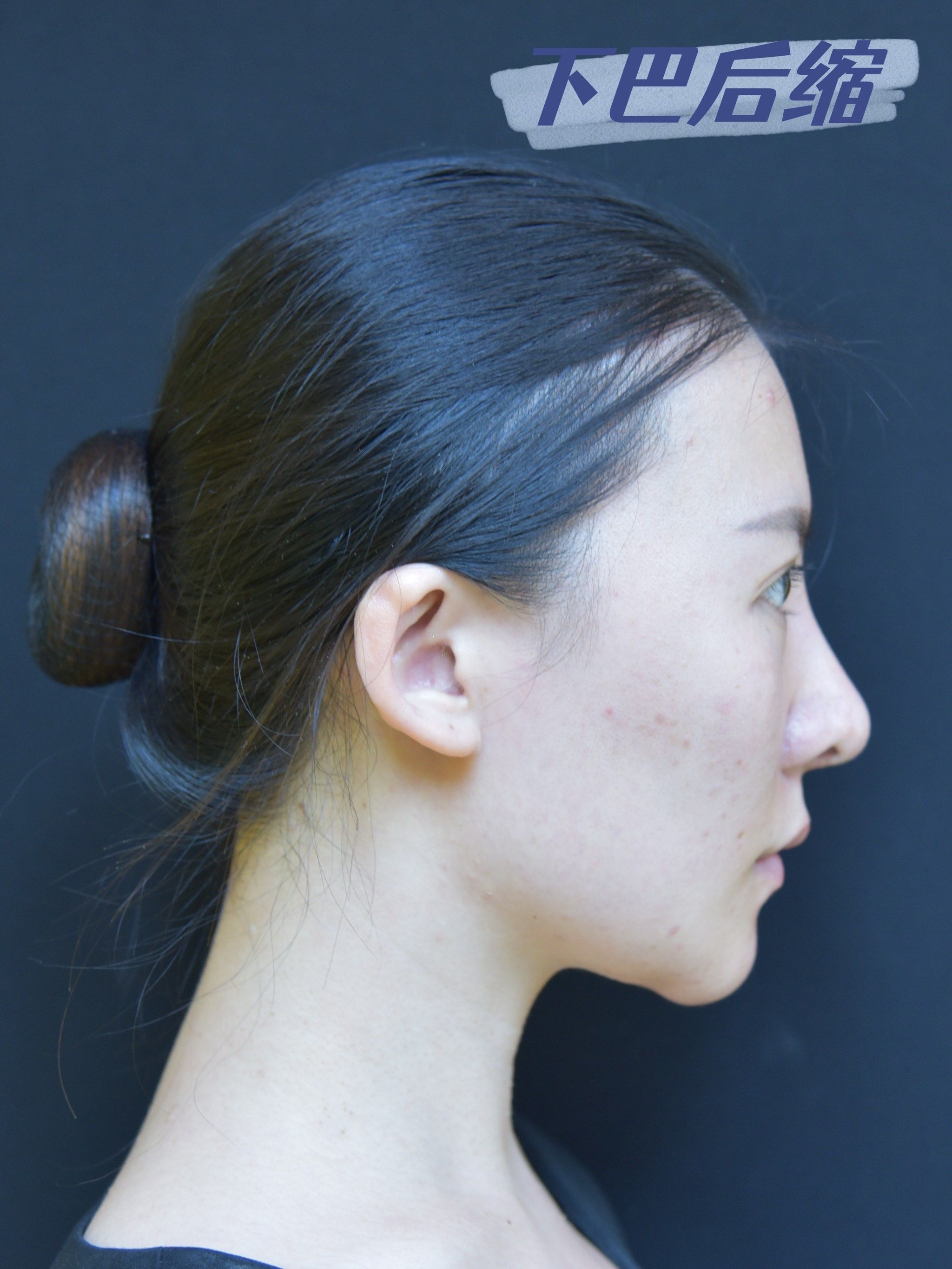 不是所有的下巴后缩都叫"幼态脸"! 法思丽玻尿酸分享