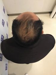 点击看大图 体验前-大麦微针植发丨全国连锁