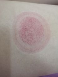 -苗塑堂减肥艾灸