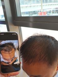 -碧莲盛·不剃发植发