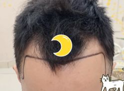 -大麦微针植发全国连锁