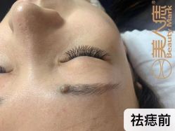 -美人痣全国连锁