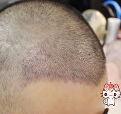 -大麦微针植发丨全国连锁