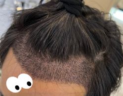 -大麦微针植发全国连锁