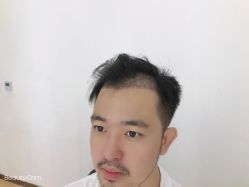 点击看大图 -大麦微针植发丨全国连锁