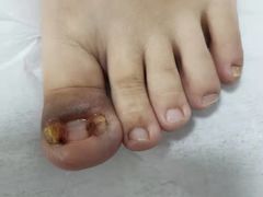 -世龙世家灰指甲鸡眼脚气甲沟炎跖疣护理(通州店)