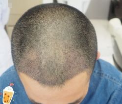 -大麦微针植发丨全国连锁