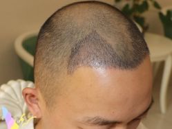 -大麦微针植发丨全国连锁