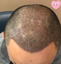 -大麦微针植发丨全国连锁