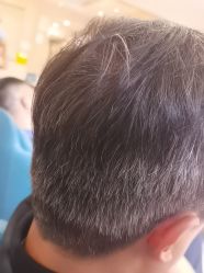 -碧莲盛·不剃发植发