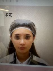 体验前-杭州米兰柏羽医疗美容医院