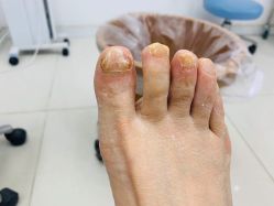 -派恩宜灰指甲鸡眼嵌甲手足癣