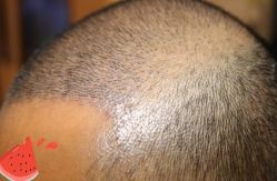 -大麦微针植发丨全国连锁