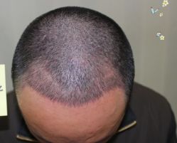 -大麦微针植发丨全国连锁