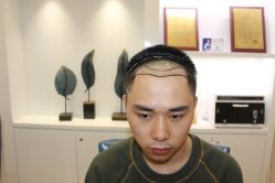 -大麦微针植发丨全国连锁