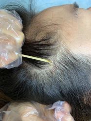 -美丽人生祛斑扁平疣汗管瘤中心