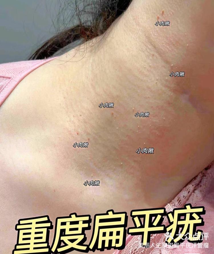 脖子上长丝状疣原因图片