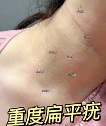 -美丽人生祛斑扁平疣汗管瘤中心