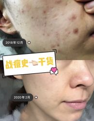 点击看大图 -苗方清颜·祛痘皮肤管理