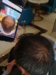 -碧莲盛·不剃发植发