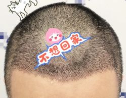 -大麦微针植发全国连锁