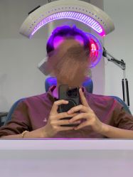 -大麦微针植发全国连锁