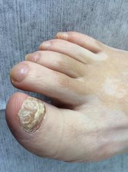 -德哥灰指甲脚气甲沟炎跖疣护理