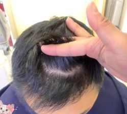 -大麦微针植发丨全国连锁