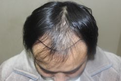 体验前-大麦微针植发全国连锁