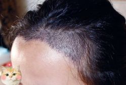 -大麦微针植发丨全国连锁