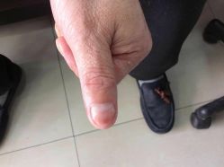 点击看大图 -德哥灰指甲脚气甲沟炎跖疣护理