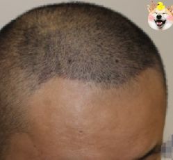 -大麦微针植发丨全国连锁