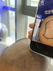 -碧莲盛·不剃发植发