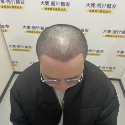 -大麦微针植发全国连锁