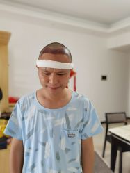 点击看大图 体验后-大麦微针植发全国连锁